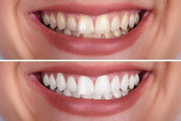 Transforming Smiles: The Versatility of Composite Bonding